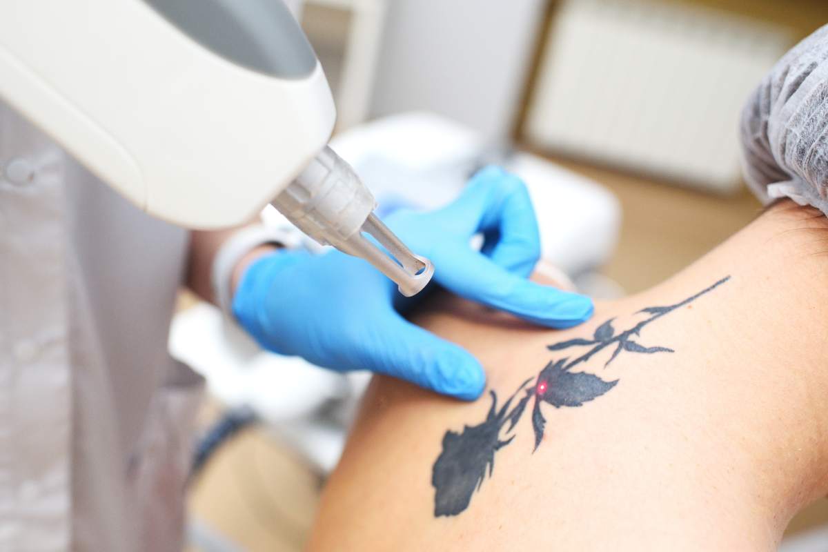 the cosmetologist removes the tattoo to the patient using a neodymium laser in a modern clinic. Hardware cosmetology